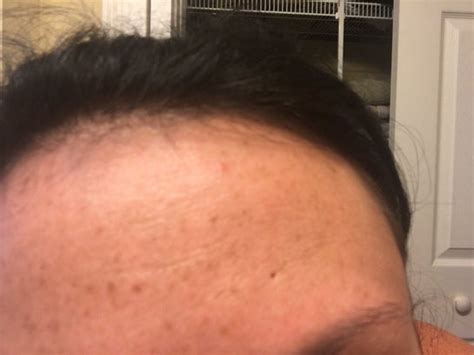 Small Hole In Skin On Forehead A Pictures Of Hole