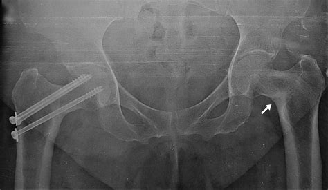 Cureus Bilateral Femoral Neck Stress Fracture In An Obese Middle Aged