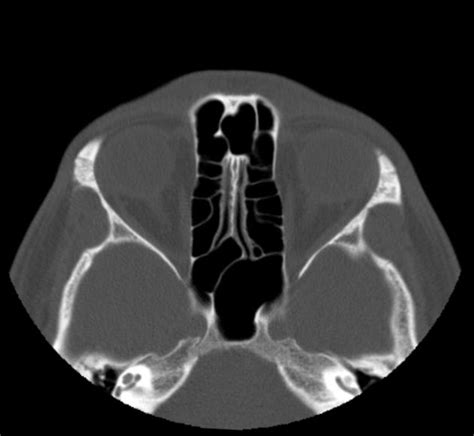 Bone comprises the structure of the skeletal system and provides lever arms for locomotion. Nasal bone fracture | Radiology Case | Radiopaedia.org