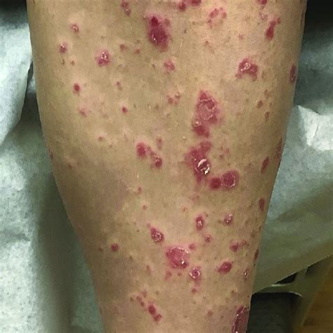 Pityriasis Lichenoides Lesions With Trailing Scale On The Upper Portion