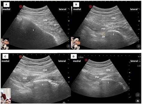 Frontiers Ultrasound Guided Measurement Of Piriformis Muscle Thickness To Diagnose Piriformis