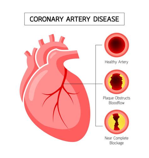 Coronary Artery Disease Illustrations Royalty Free Vector Graphics