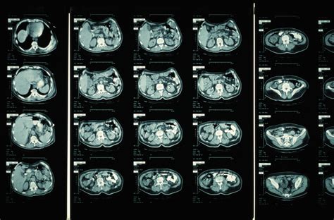 brain cat scan procedure