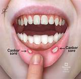 A common type of ulcer but the least problem of all the three. Canker Sores: Causes, Symptoms, Treatment & Prevention