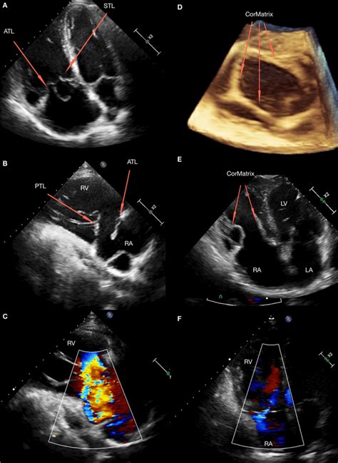 A B Transthoracic Echocardiography At Admission Tricuspid Valve