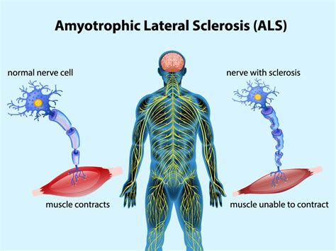 Growing Demand Propels Amyotrophic Lateral Sclerosis Market To Record
