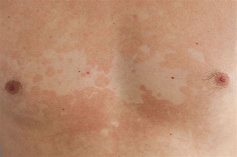 Skin Yeast Infection Tinea Versicolor Guide Images And Photos Finder