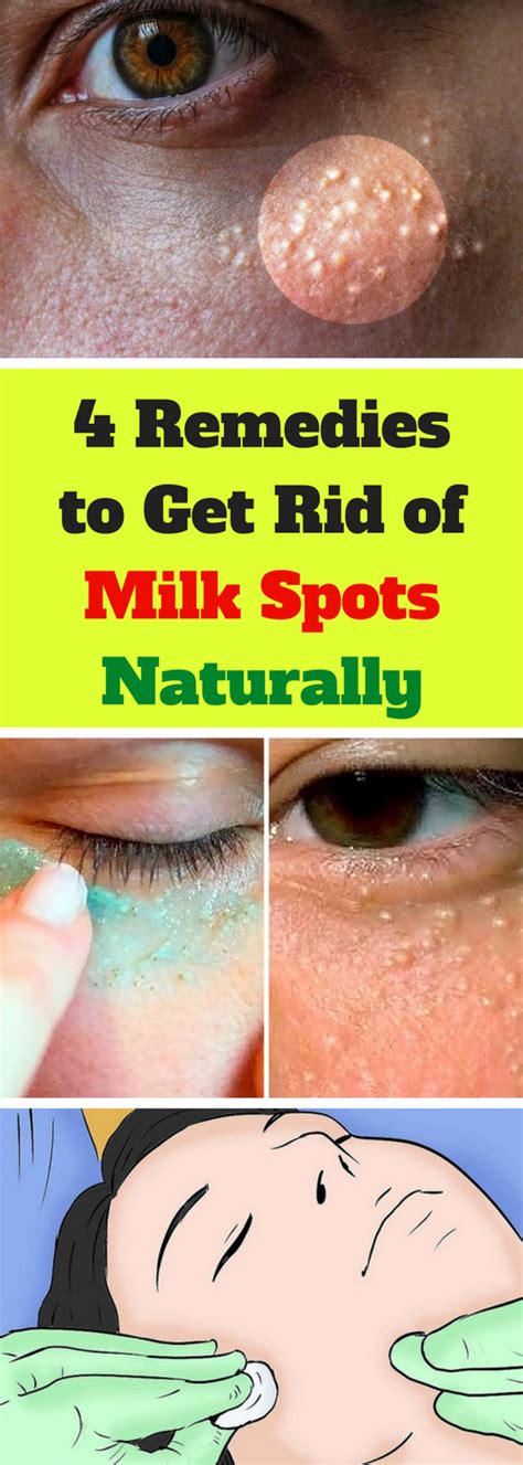 Milia Also Known As Milk Spots Is A Harmless Skin Disorder Which