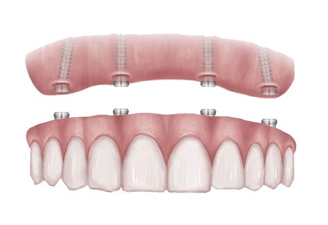 All-on-4® Dental Implants Danbury, CT | Rolling Hills Dentistry