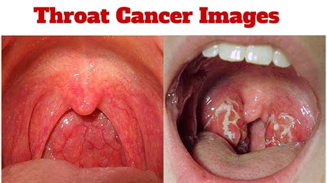 Throat Cancer Introduction Types Symptoms And Treatment