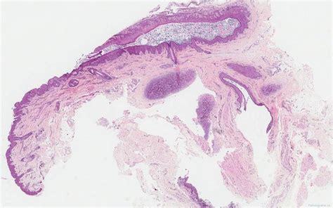 Branchial Cleft Cyst Archives Atlas Of Pathology