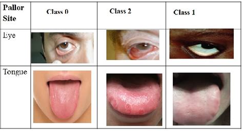 Pdf Computer Aided Detection Of Anemia Like Pallor Semantic Scholar