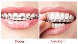 Pictures of Dental Insurance Braces