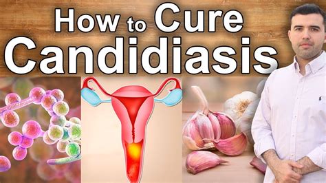 Natural Treatment Effective Against Candidiasis How To Cure Candida Naturally Youtube