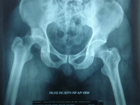 X Rays And Slides Posterior Dislocation Of Right Hip