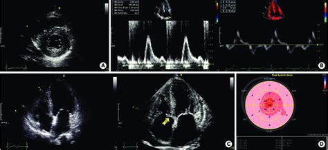 Typical Echocardiography Features In Cardiac Amyloidosis Patients A