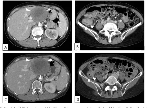 Figure 1 From Retroperitoneal Schwannoma Preoperatively Diagnosed As