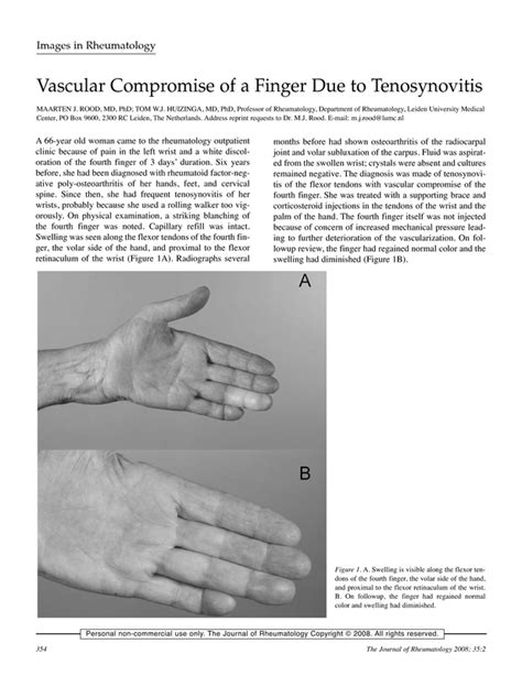 Vascular Compromise Of A Finger Due To Tenosynovitis The Journal Of