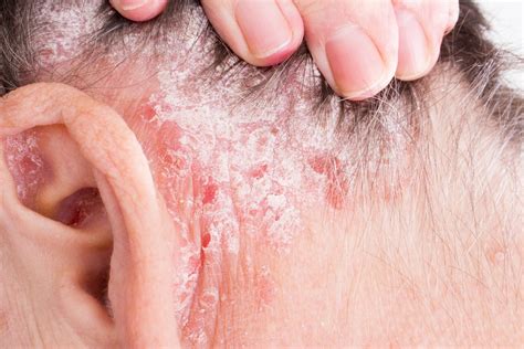Costras en el cuero cabelludo por qué sale la dermatitis seborreica y cómo se elimina