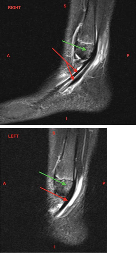 Bilateral Peroneal Tendon Subluxation Of An Adolescent Female With Mri Correlations