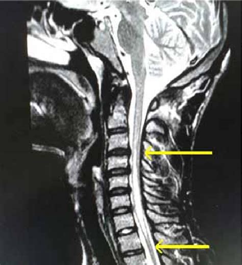 Spinal Lesions On Mri
