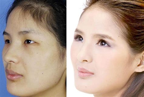20 Chinese Women Before And After Plastic Surgery Design You Trust