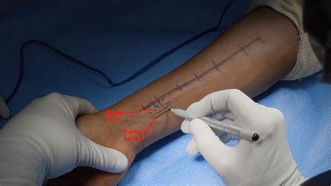 Tendon Transfers To Restore Function Following Radial Nerve Avulsion
