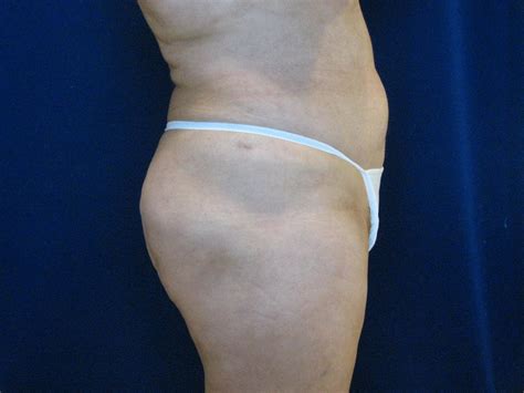Abdominoplasty Before And After Lv Plastic Surgery