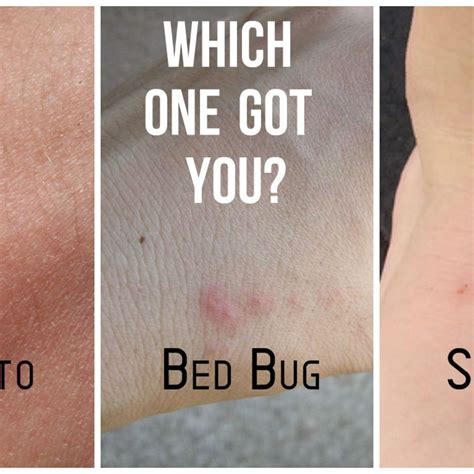 Whats The Difference Between Bed Bug Bites And Mosquito Bites Bedbugs