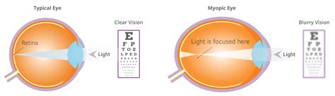 Toronto Myopia Control Clinic Treatment For Nearsightedness