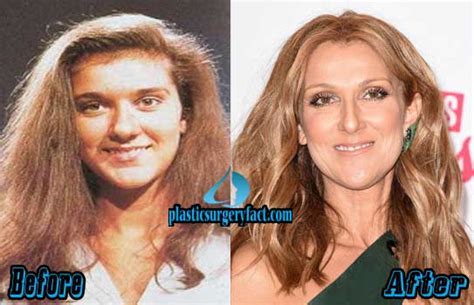 Celine Dion Plastic Surgery Before And After Pictures