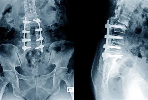 Lumbar Spinal Fusion Surgery For Lower Back Pain