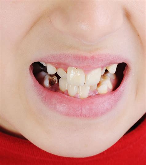 7 Causes Behind Discolored Teeth In Children And Treatment