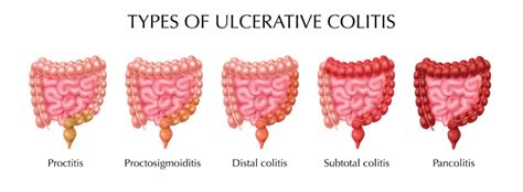 What Is Pancolitis Symptoms Causes And Treatment