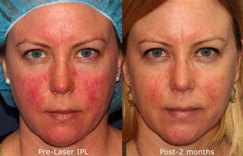 Ipl Photofacial Treatments By San Diego Dermatology Experts