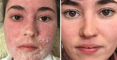 Woman Makes Incredible Eczema Recovery After Ditching Steroid Creams