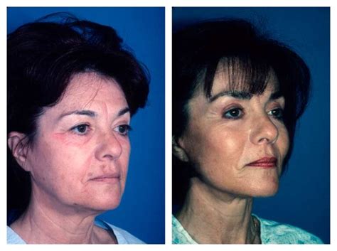 Beverly Hills Facial Contouring Surgery Dr Applebaum
