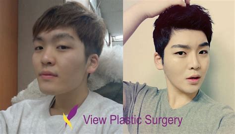 Top Kpop Idols Who Had Plastic Surgery Tips Goya