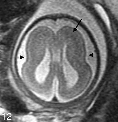 Magnetic Resonance Imaging Of The Fetal Brain And Spine An