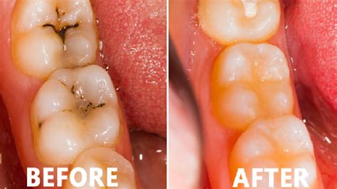 Reverse and protect against tooth decay. How to Reverse Tooth Decay? - Woodleigh Waters Dental ...