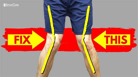 The Best Ways To Fix Knock Knees At Home Youtube