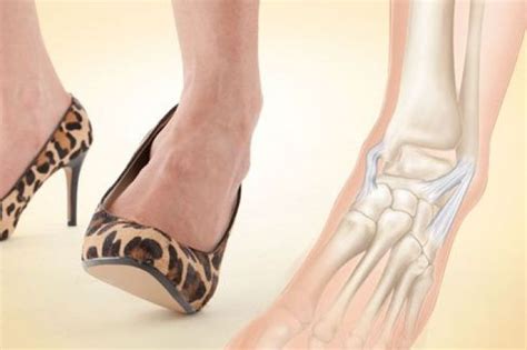 The Pain And Pleasure Of Wearing High Heels Resurgens Orthopaedics