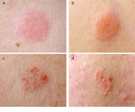 Figure 3 From Allergic Contact Dermatitis Semantic Scholar