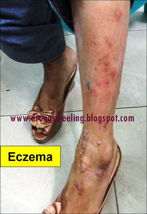 Tcm News How Effective Can Tcm Cure Eczema 湿疹
