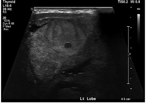 Ultrasound Neck Showing Enlarged Left Thyroid Lobe Download