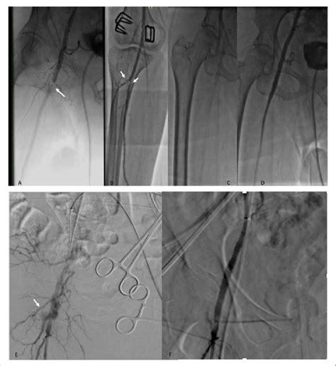 A Thrombus At The Common Femoral Artery Cfa Arrow After Download Scientific Diagram