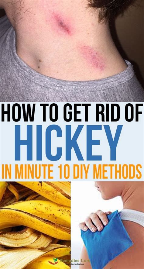 How To Remove Bad Hickeys Howtoremvo