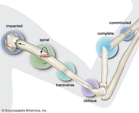 Fracture Types Causes And Symptoms Britannica