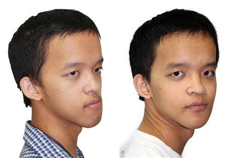 Facial Asymmetry Correction Corrective Jaw Surgery Dr Antipov
