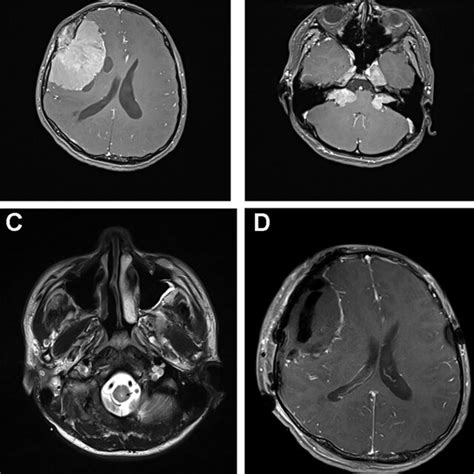 Radiologic Findings Of Brain Tumors In A Patient With Neurofibromatosis